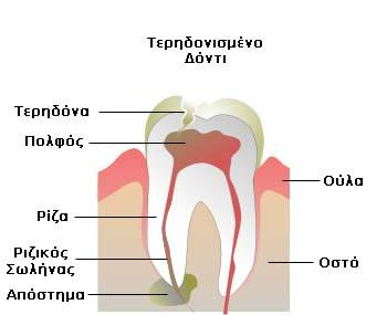 Odontiko-apostima-1