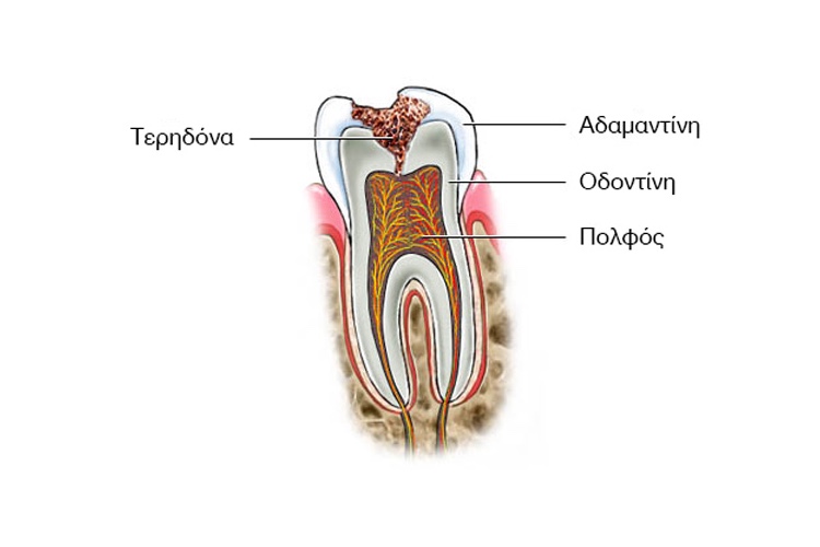 Teridona-2