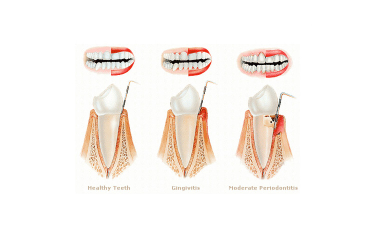 oulitida-periodontitida-23